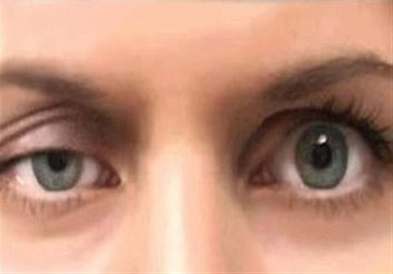 علائم و خطرات سکته چشمی علائم و خطرات سکته چشمی