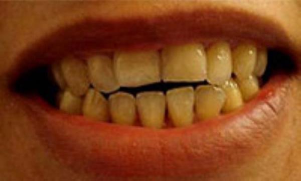 علل بد شکلی و بد رنگی دندان